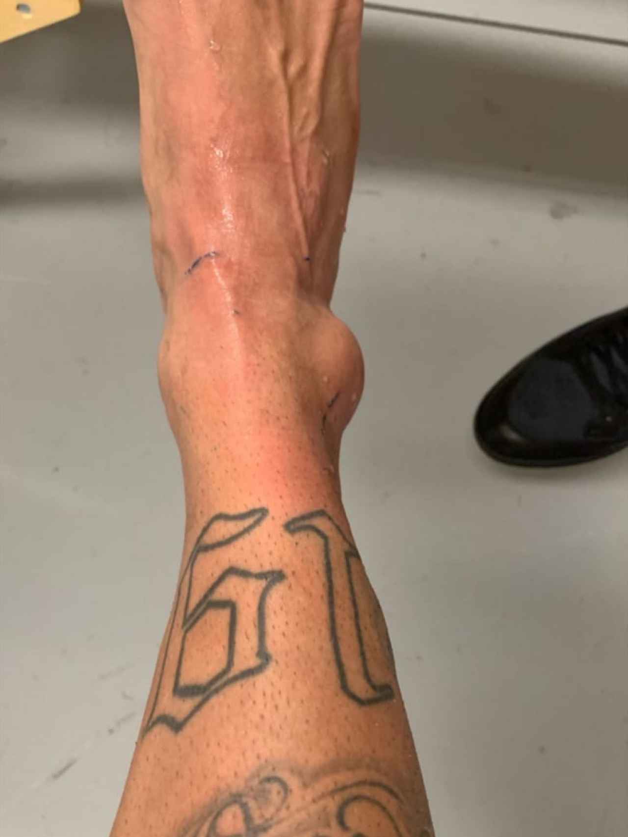Así quedó el tobillo de Neymar tras lesionarse ante Catar