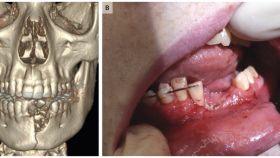 Imágenes de la boca del joven difundidas por The New England Journal of Medicine.