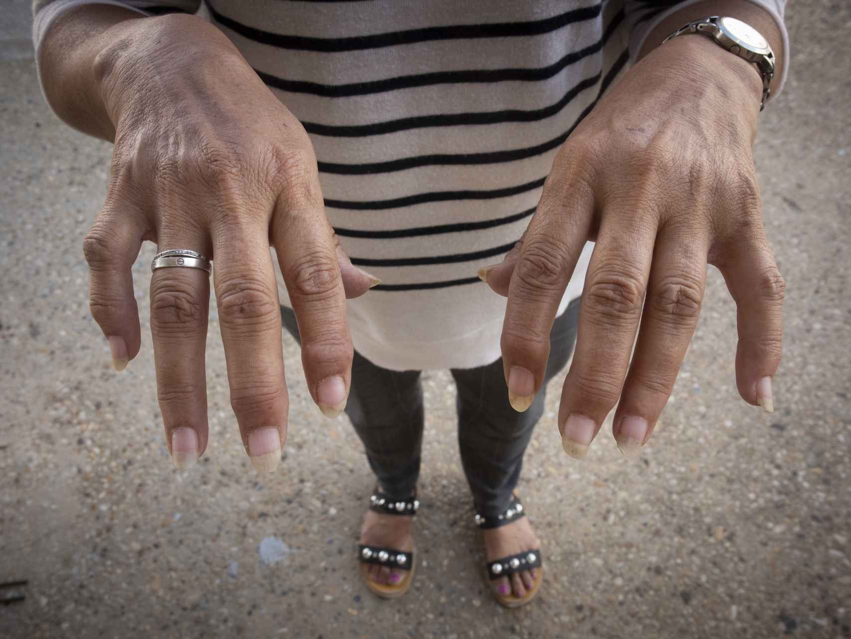 Juana Hermoso muestra sus manos entumecidas producto de la epicondilitis que padece.