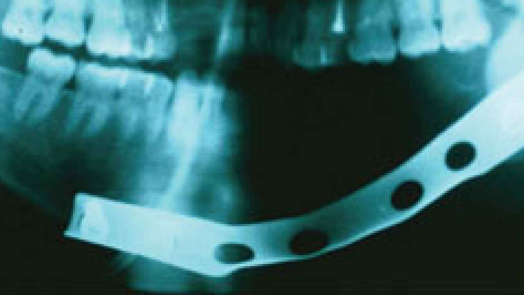 Reconstrucción de mandíbula con placas.