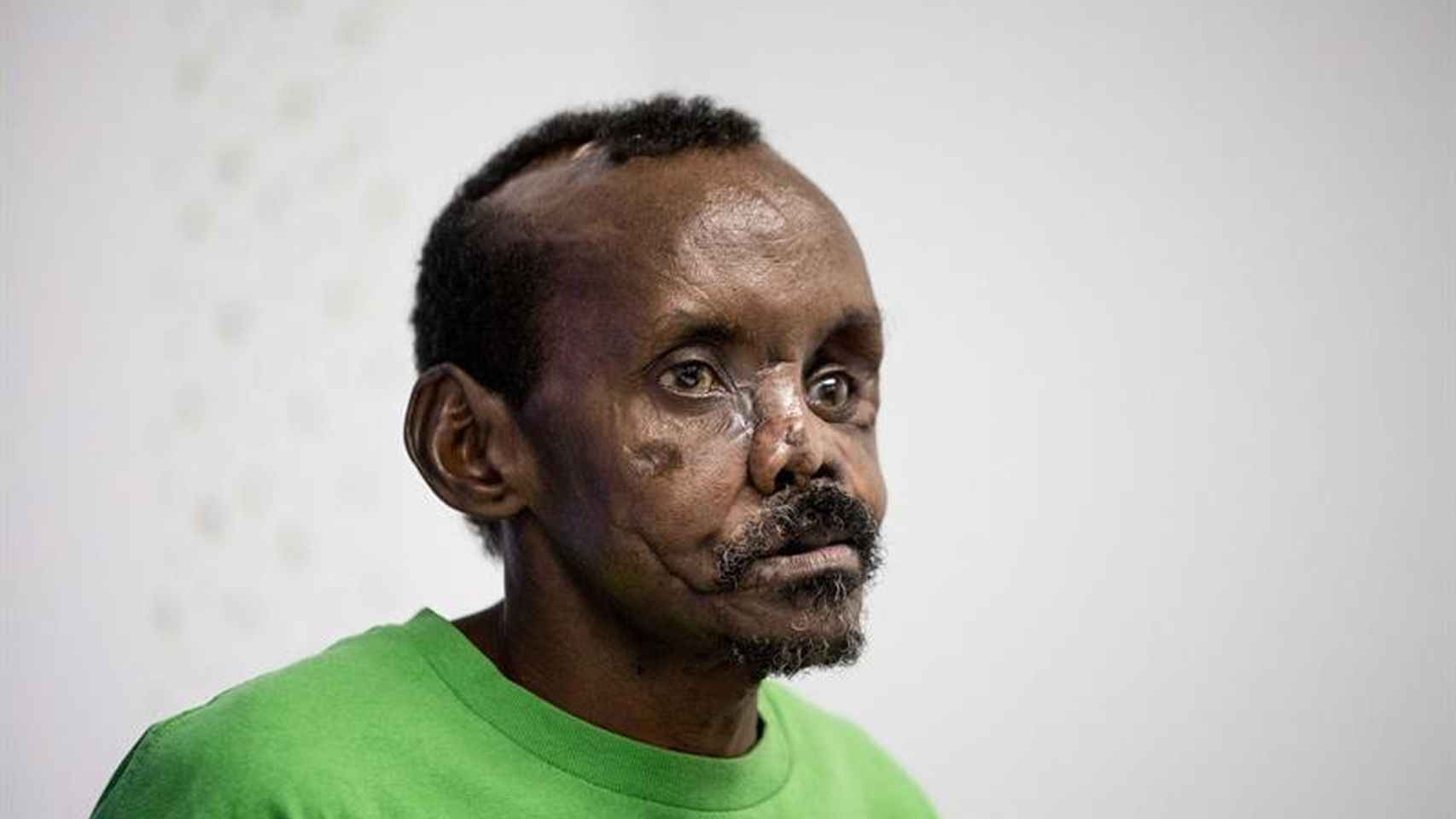 El pastor keniata Lonunuku, de 58 años, tras la reconstrucción parcial del rostro y la mano izquierda
