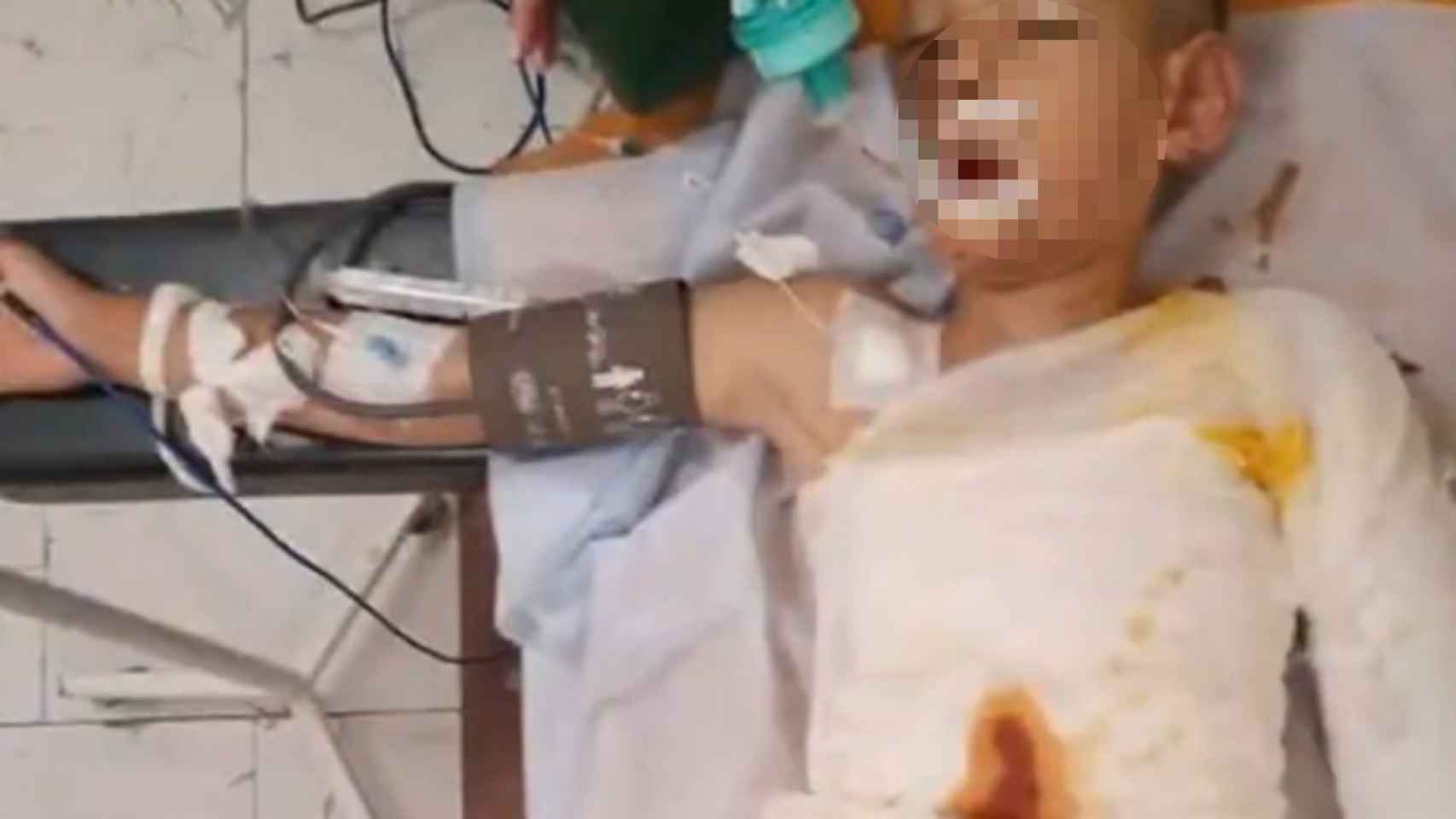 El niño se encuentra en estado crítico en un hospital de Ucrania.