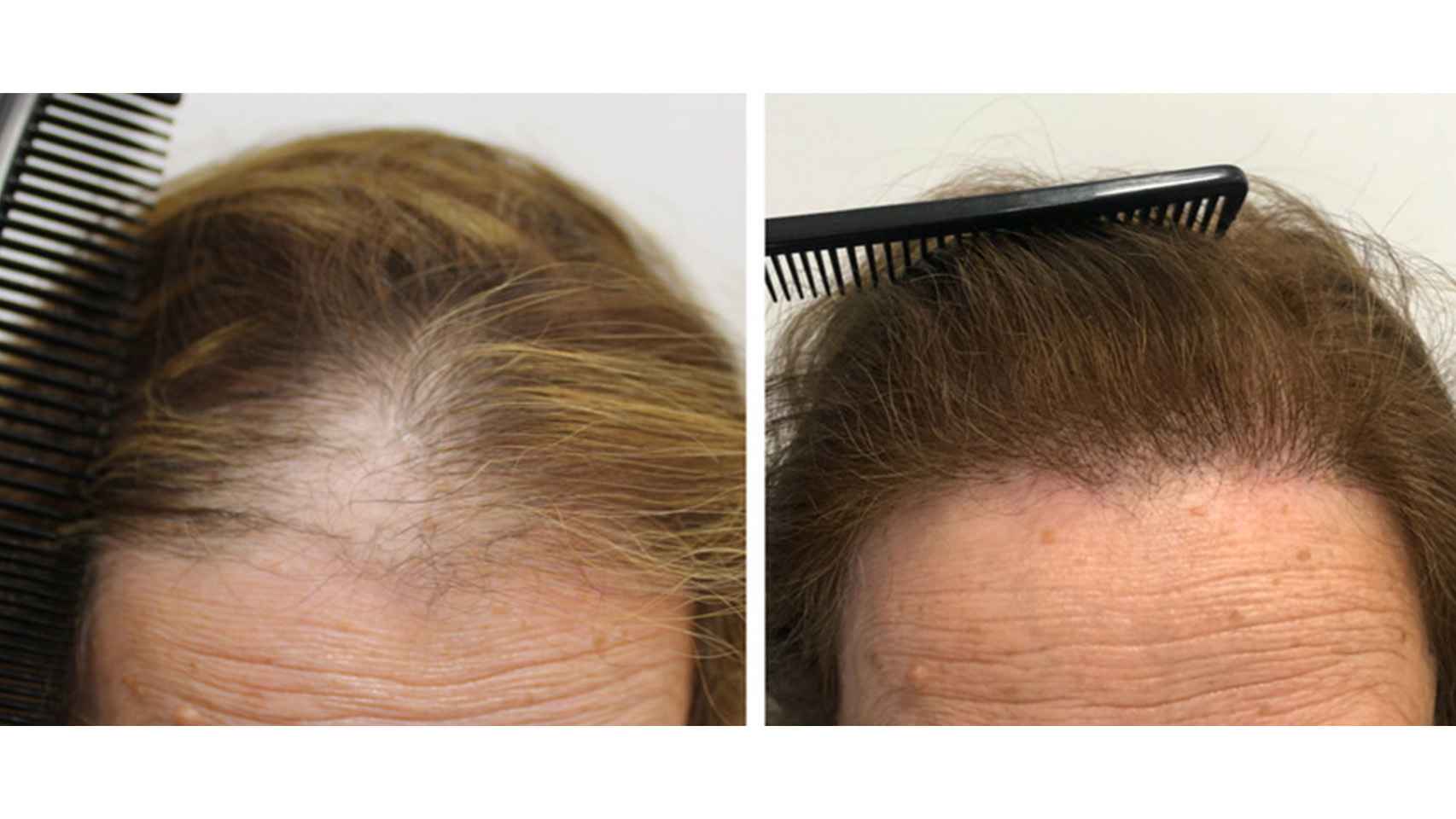 La mayoría de las mujeres sufren alopecia en la zona de la raya del pelo.