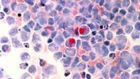Células tumorales de leucemia.
