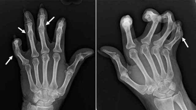 Radiografía de las manos de una enferma de artritis. Learningradiology.com