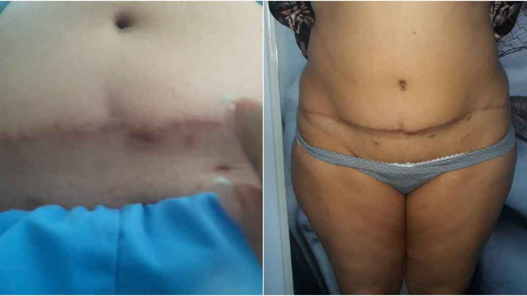 El abdomen de Máxima, nueves meses después de su operación de estética.