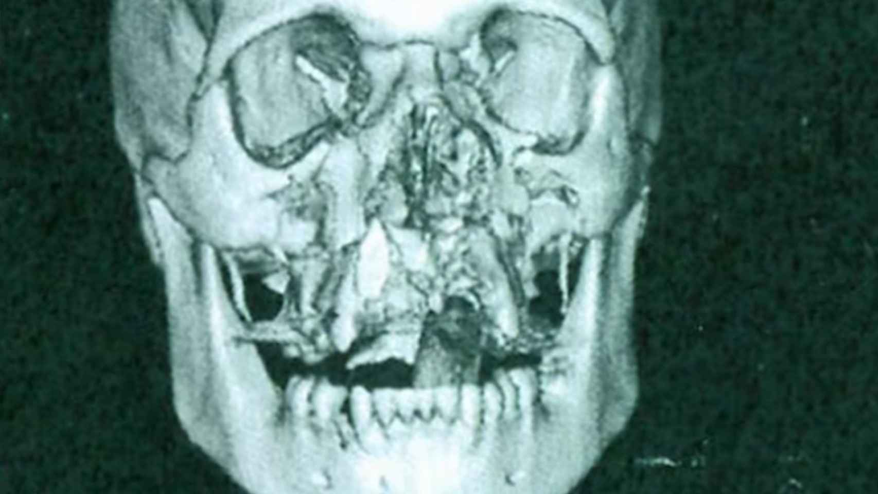 Una radiografía de la cara de Jack tras el incidente.