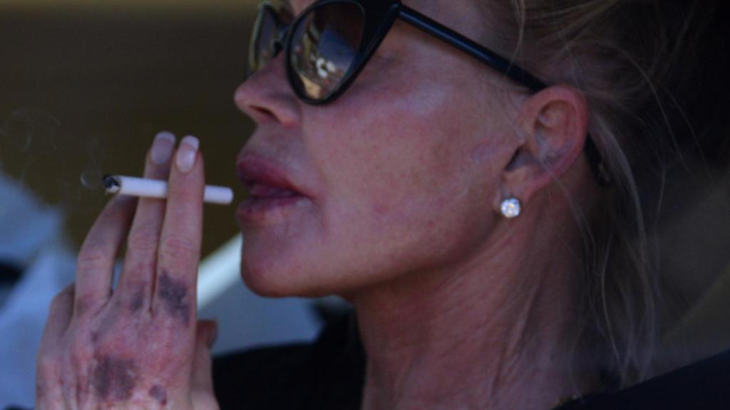 Melanie, en Hollywood con varios hematomas en sus manos.