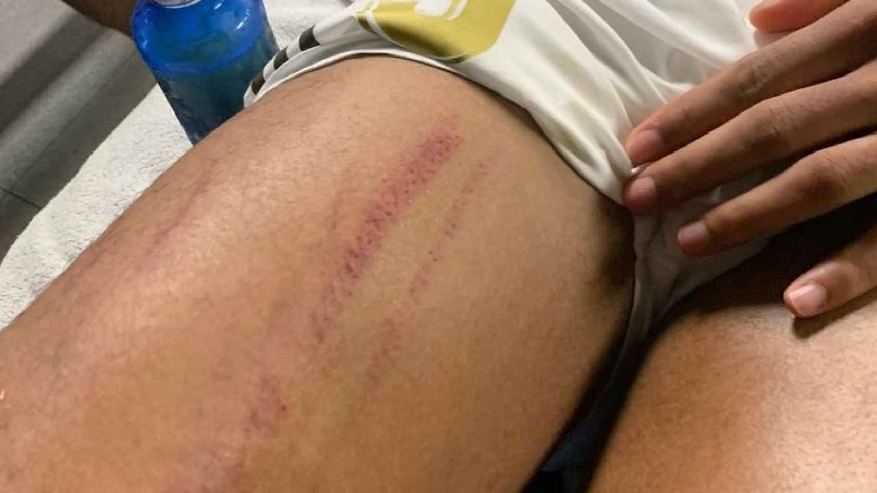 La herida en la pierna de Varane tras el partido