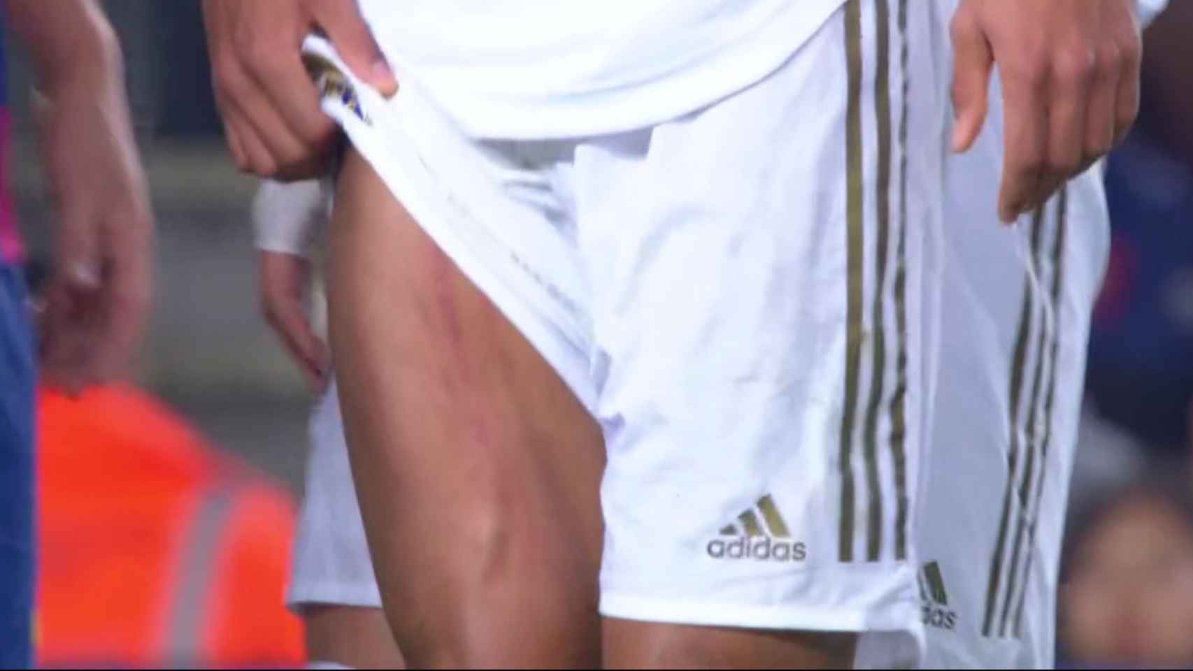 Varane muestra la herida en la pierna tras la patada de Lenglet