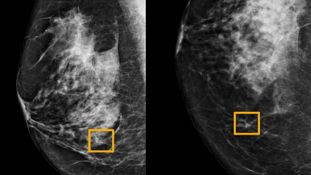 A yellow box indicates where an artificial intelligence (AI) system found cancer hiding inside breast tissue