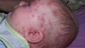 Un bebé con varicela