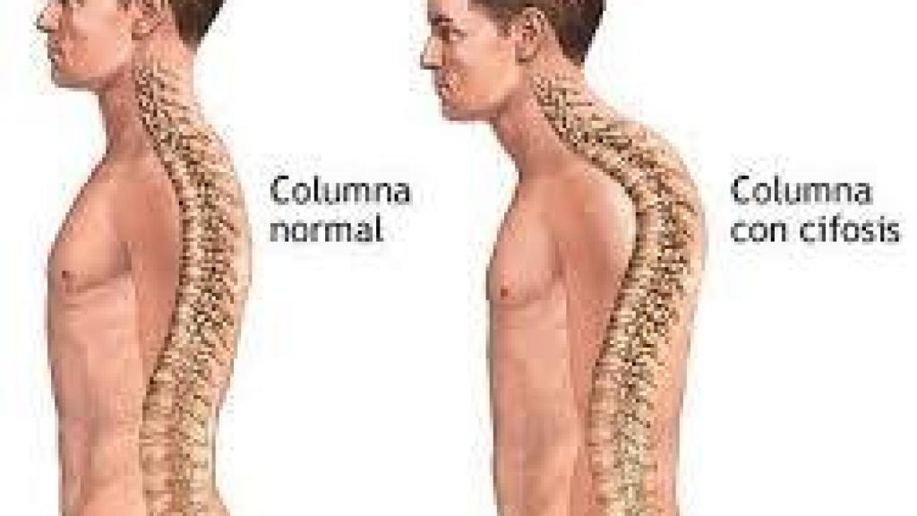 Ejemplo de columna normal y columna afectada de cifosis dorsal.