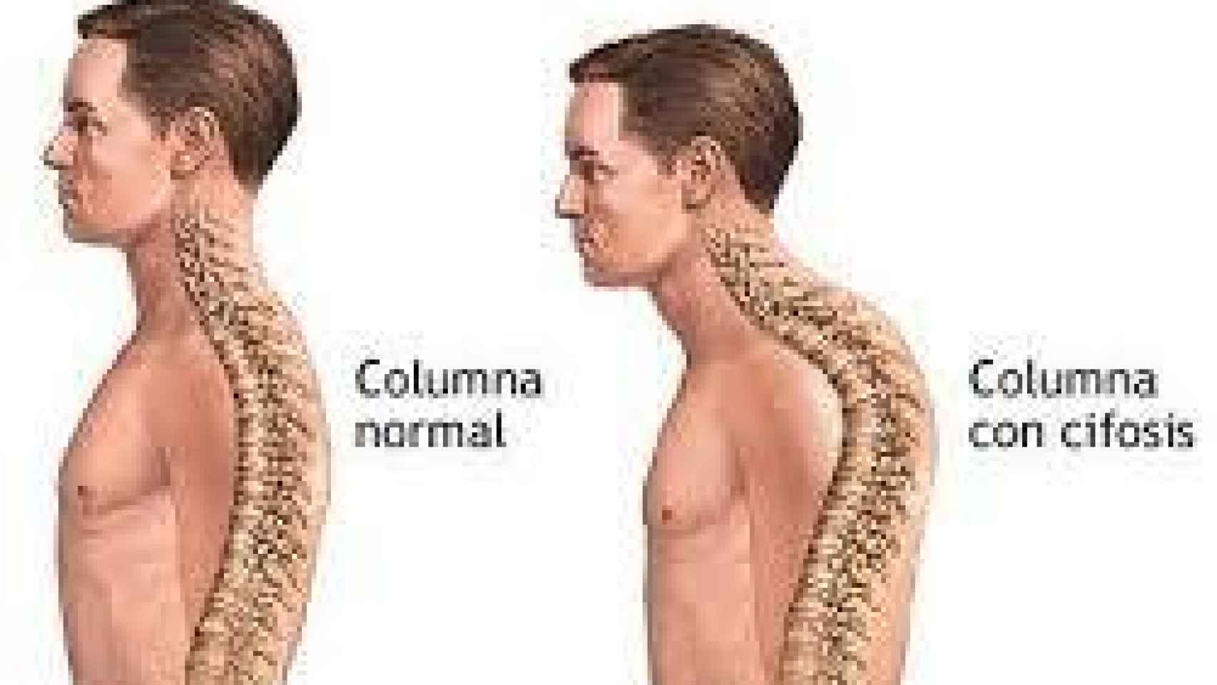 Ejemplo de columna normal y columna afectada de cifosis dorsal.