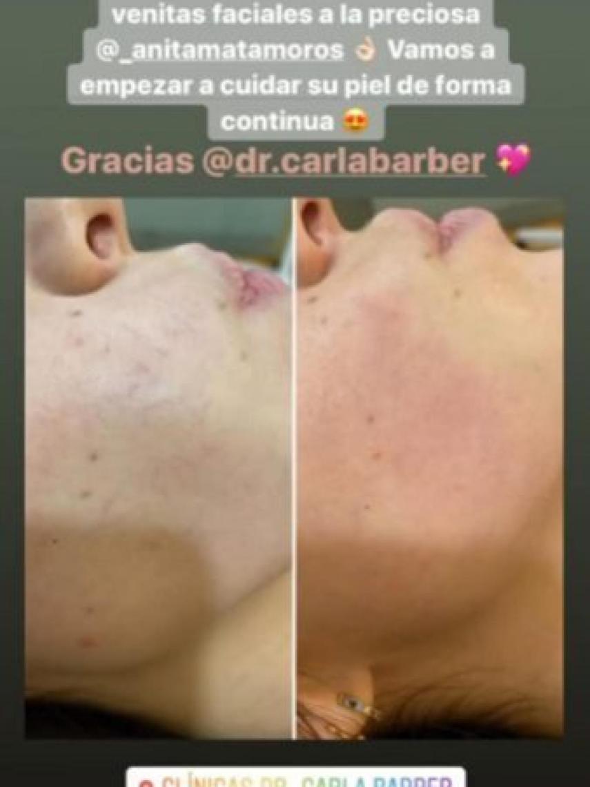 El tratamiento que se aplicó para eliminar las venas faciales.