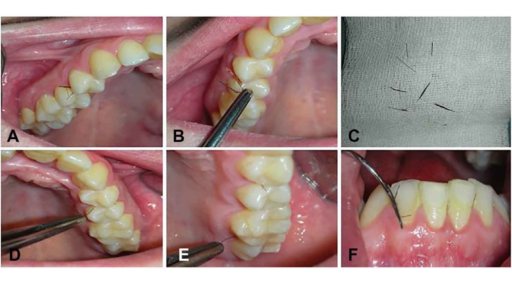 El tratamiento a la paciente afectada por hirsutismo gingival. Oral Surgery, Oral Medicine, Oral Pathology, Oral Radiology.