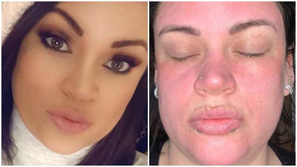 Candice compartió el resultado de la crema facial a través de sus redes sociales.