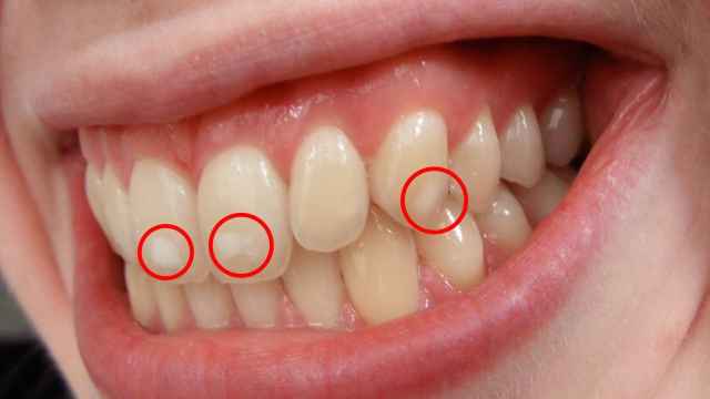 Dental fluorosis. josconklin / Wikimedia Commons