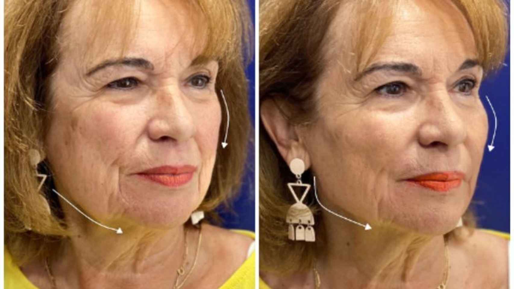 El doctor Ángel Martín ha creado este innovador tratamiento facial.