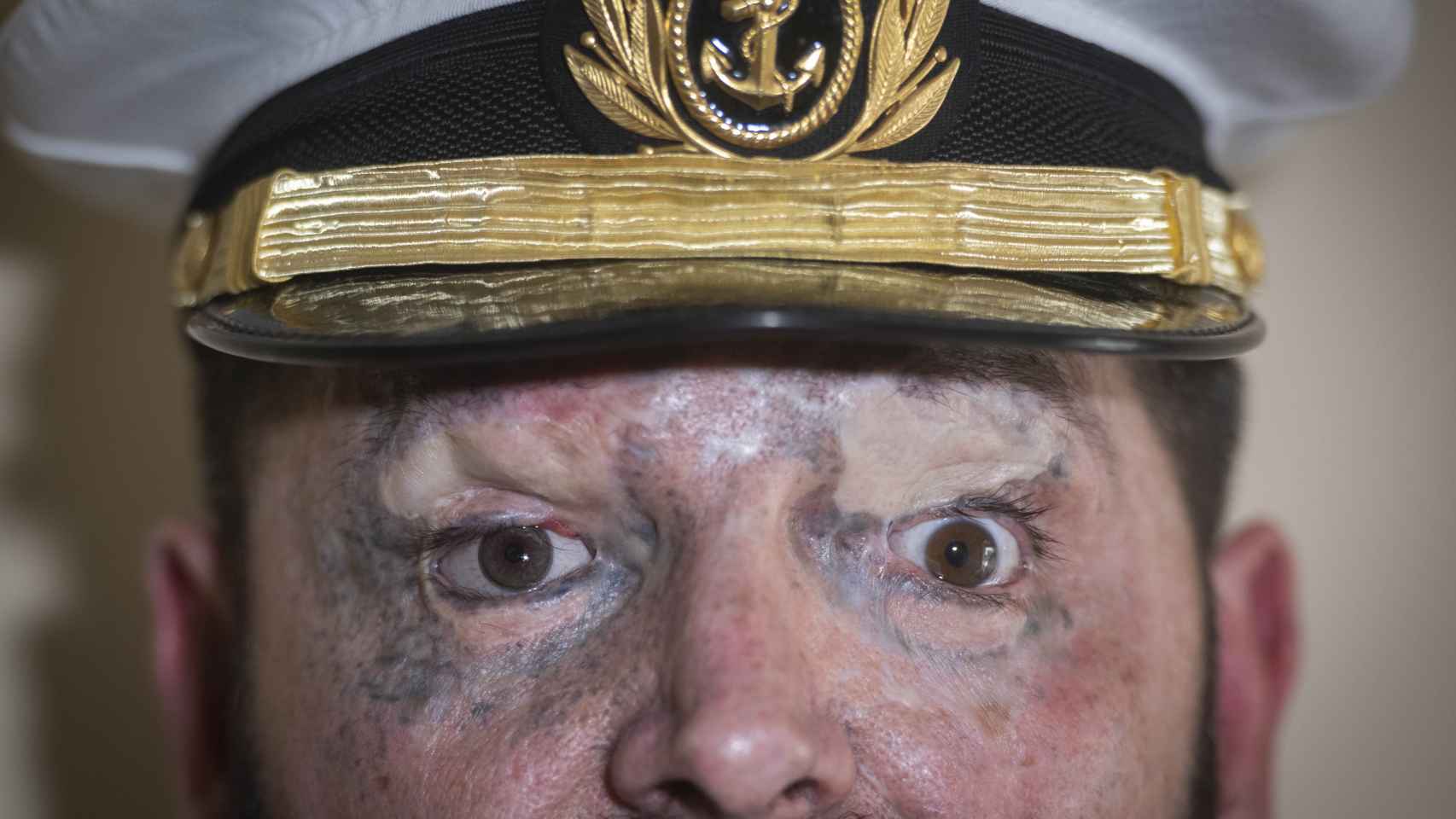 José Manuel Candón perdió el ojo derecho, en el que lleva una prótesis ocular, y le mantiene un 20% en el izquierdo.