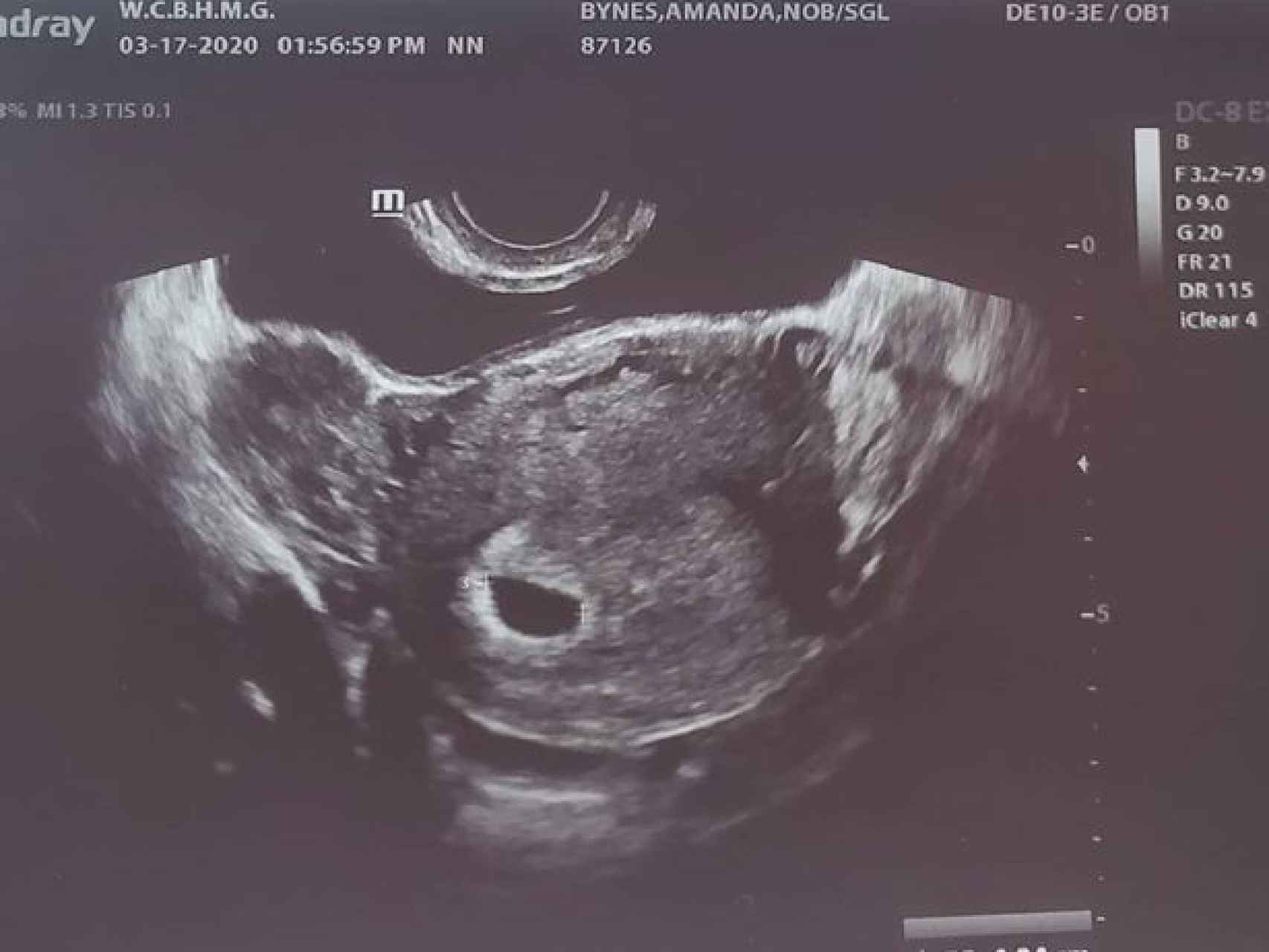 Captura de la ecografía del futuro bebé de Amanda Bynes.