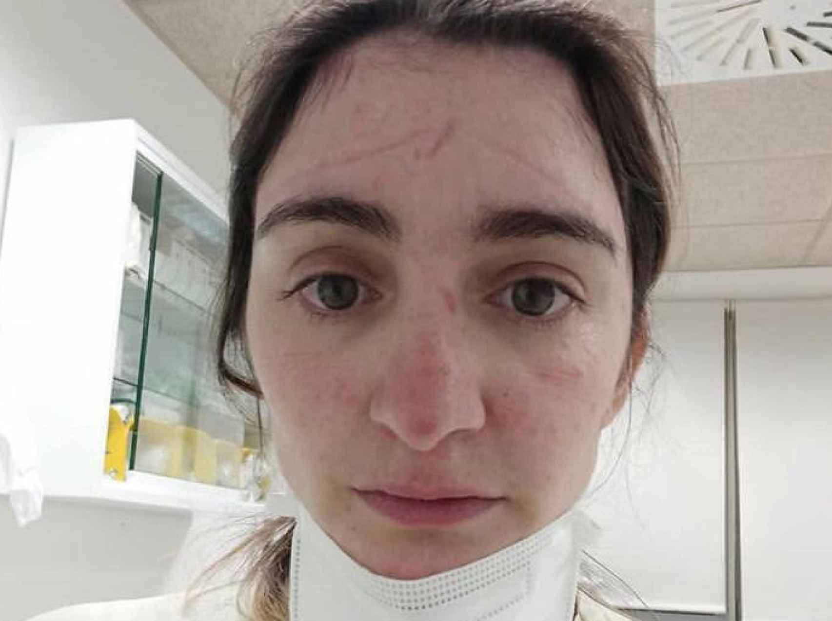 Una enfermera del Hospital Infanta Sofía muestra las marcas de su cara por los EPIs.