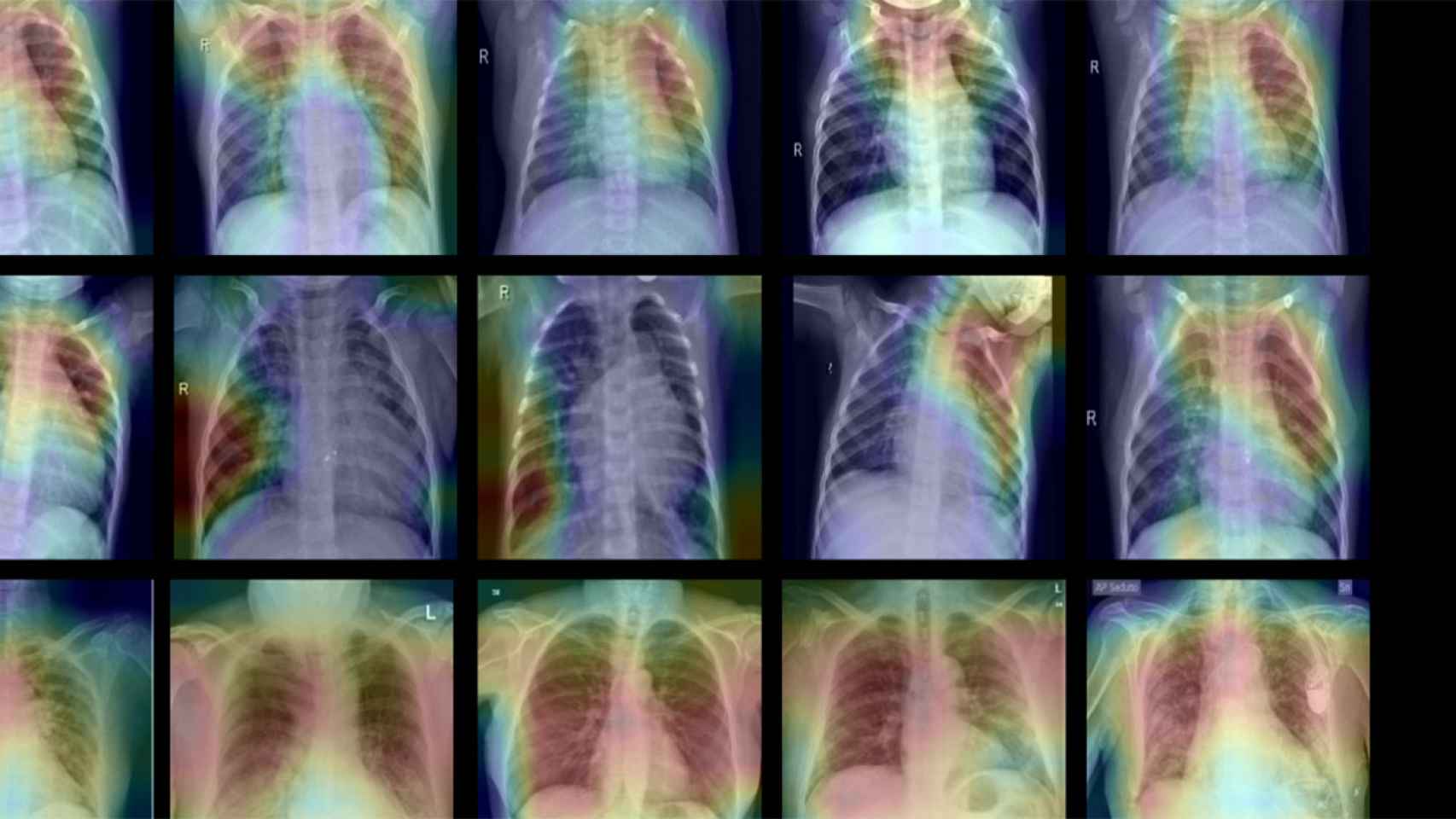 Radiografías para discernir entre neumonía y COVID-19.