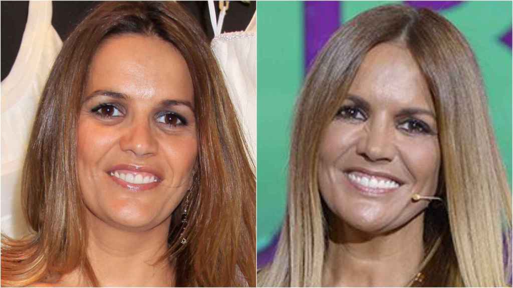 Marta López antes y después de su tratamiento antiojeras.
