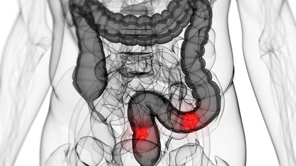 cancer de colon en jovenes sintomas