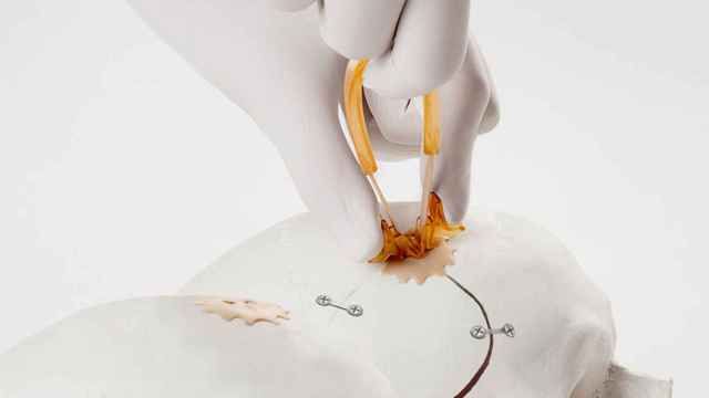 La catalana NEOS Surgery sella la hernia discal casi sin tocar