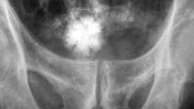 Una radiografía muestra un cálculo renal en el cuerpo de un sujeto.