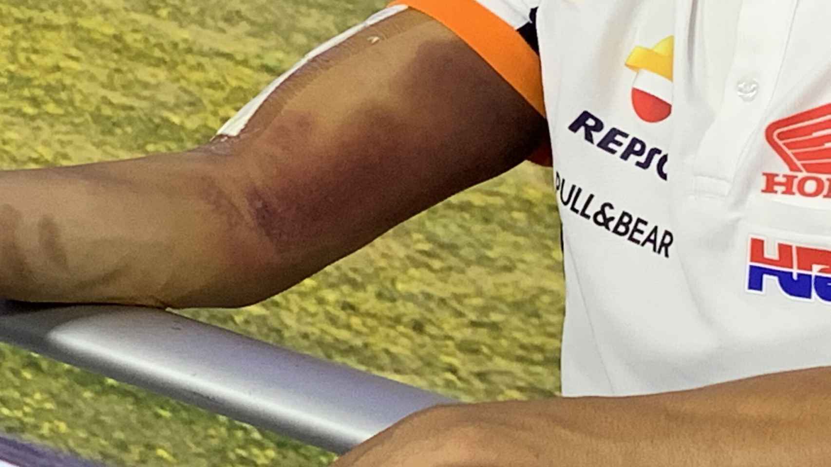 La imagen del brazo de Marc Márquez que le ha impedido correr el Gran Premio de Andalucía