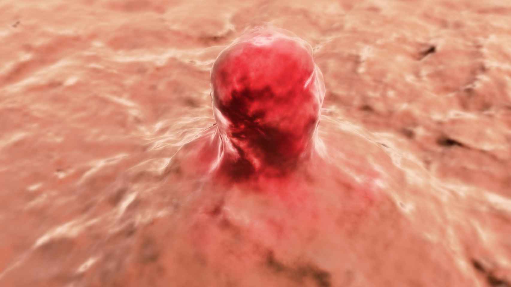 Simulación de un carcinoma de piel.