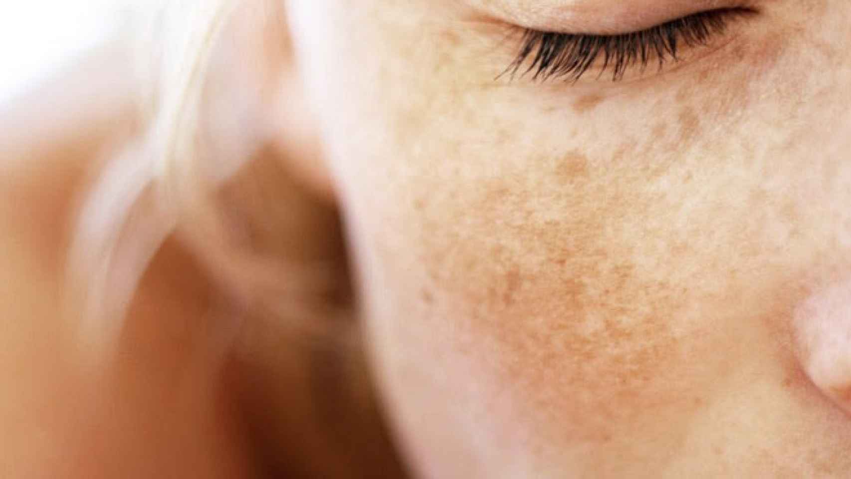 Este es el novedoso tratamiento que combate y frena el melasma del rostro