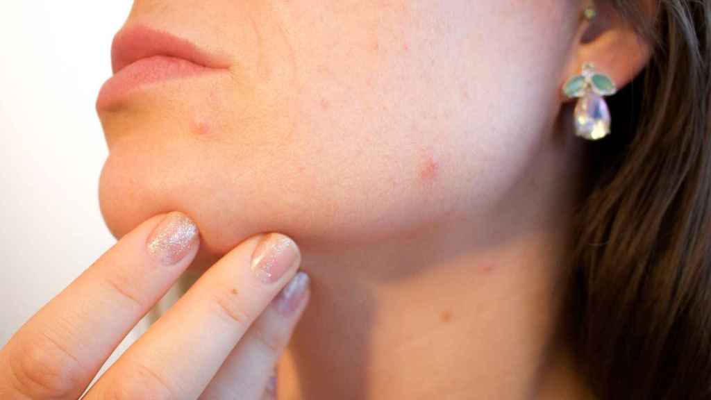 Las mascarillas fomentan la aparición de acné en el rostro
