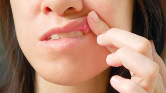 Diez remedios para las úlceras bucales