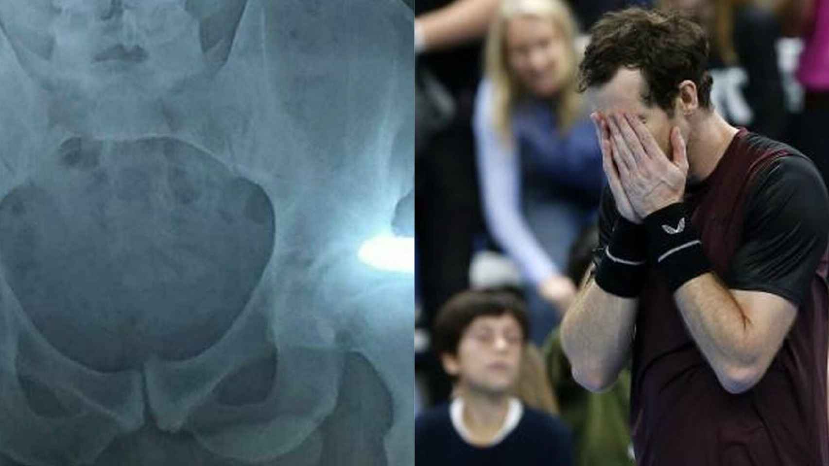 Andy Murray y su radiografía de cadera