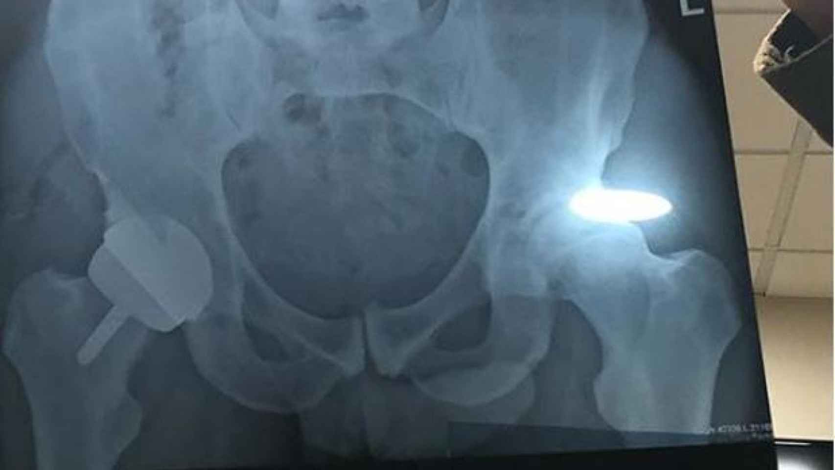 La radiografía de cadera de Andy Murray