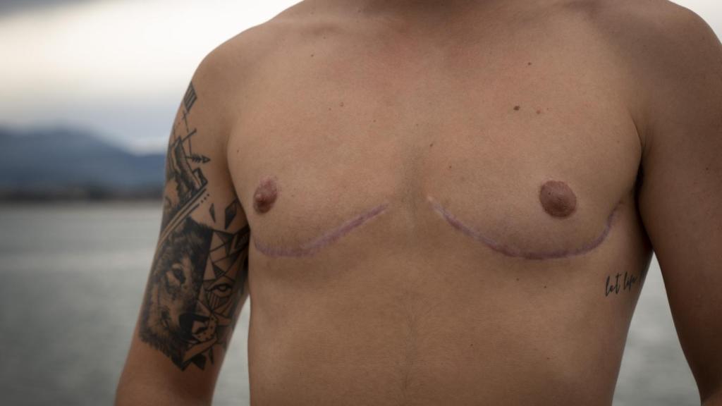 Se sometió a una mastectomía bilateral en diciembre de 2019.