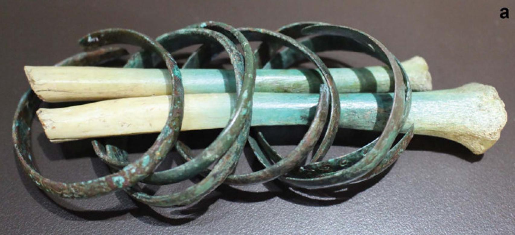 El brazo amputado de la adolescente y las pulseras de cobre.