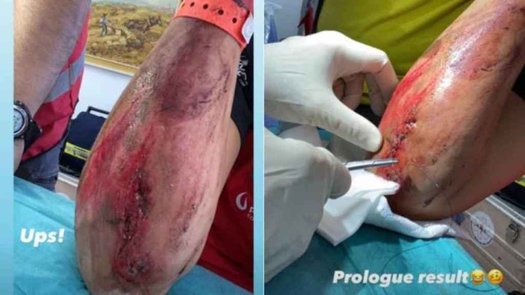 El codo de Laia Sanz tras recibir varios puntos de sutura por una caída en el Rally de Andalucía