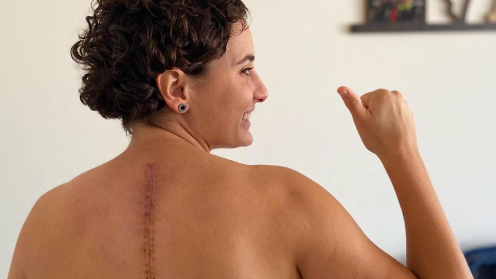 Ana Carrasco muestra la cicatriz de su espalda