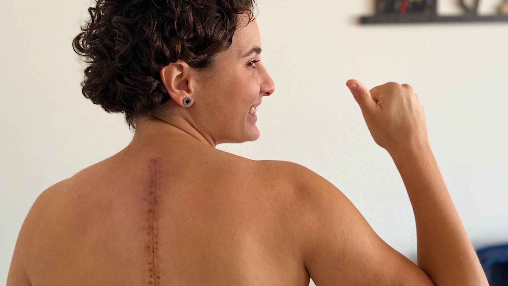 Ana Carrasco muestra la cicatriz de su espalda