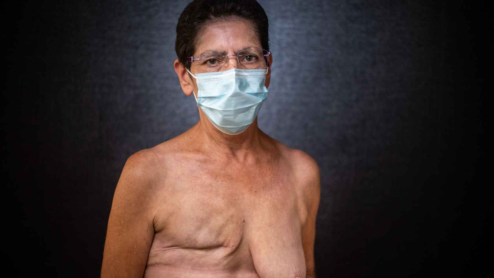 Josefa González tiene una mastectomía del pecho derecho.