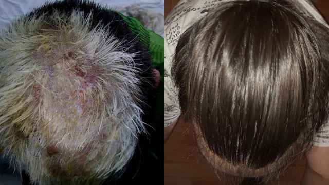 Imagen de las quemaduras provocadas en el cuero cabelludo del joven.
