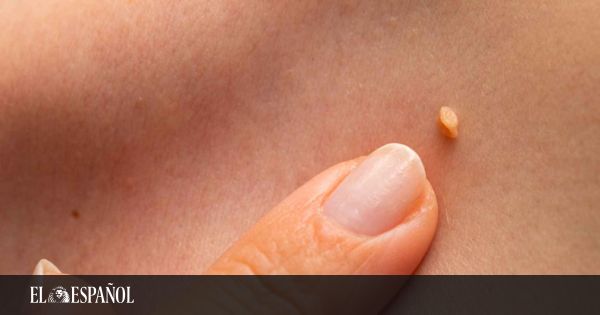 Verrugas papiloma genitales - Que son los papilomas genitales