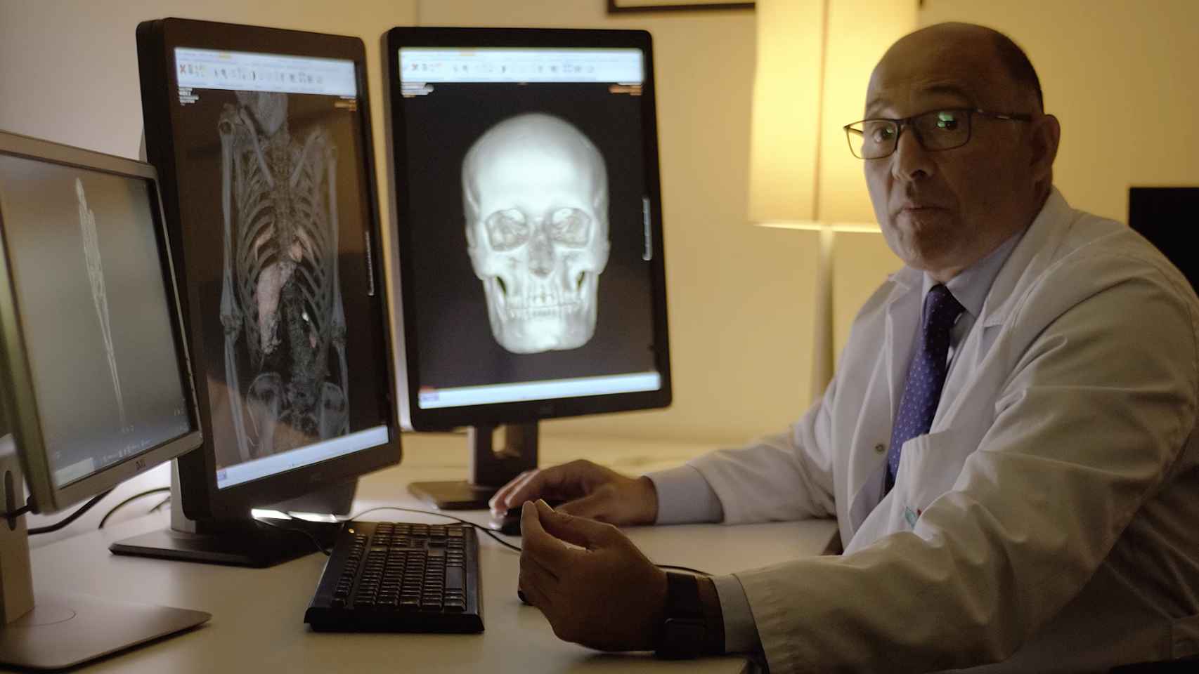 El doctor Javier Carrascosa interpretando los resultados de la Tomografía Axial Computarizada realizada a la momia guanche, donde se aprecian sus órganos internos.