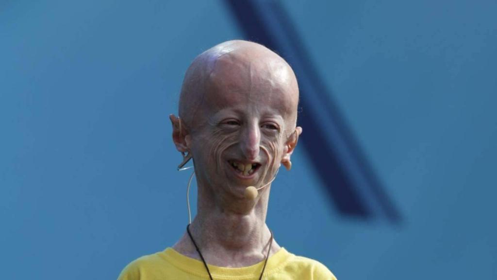 Sammy Basso, biólogo molecular y enfermo de progeria.