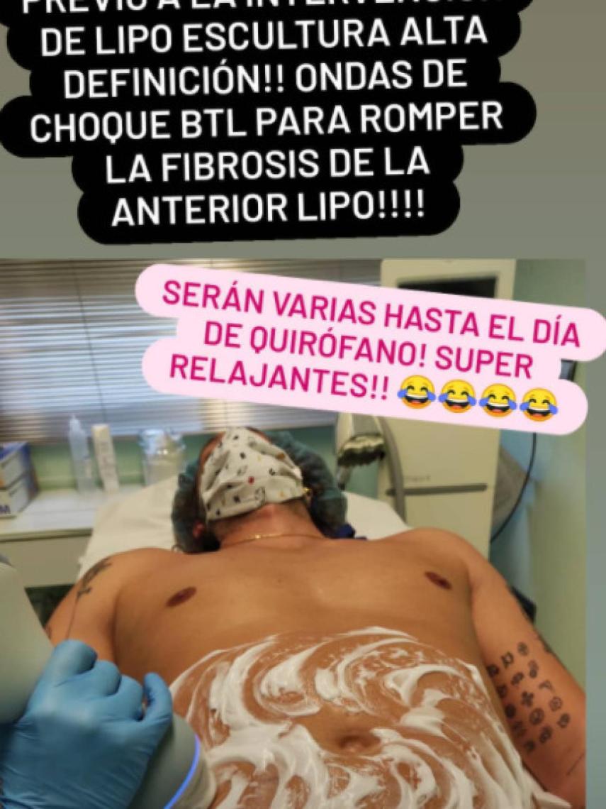José Antonio León se ha sometido a una lipoescultura abdominal de alta definición.