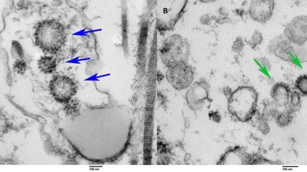 Coronavirus detectado en el tejido testicular de un paciente positivo vivo (izquierda) y fallecido (derecha).